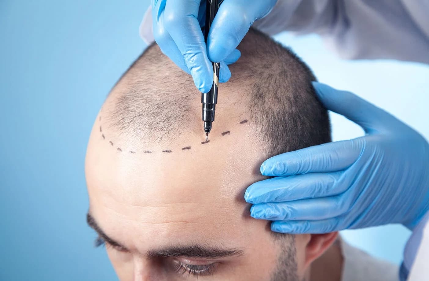 A precision aesthetic laser treatment being performed